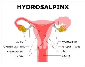 Coping With IVF