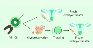  Frozen embryo transfer procedure in IVF showing embryo transfer into the uterus. 